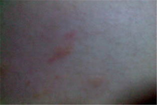 誘發蕁麻疹的常見因素有哪些